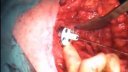 Reverse Delta Prosthesis for a Failed Shoulder Arthroplasty Part 1